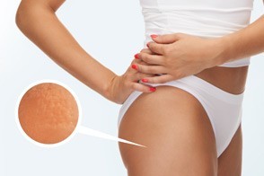 Lipomassage by Endermologie Lipomassage by Endermologie