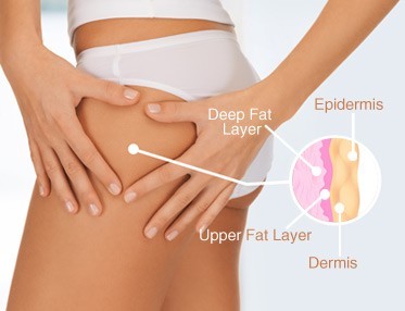 What is Cellulite & Cellulite Treatment