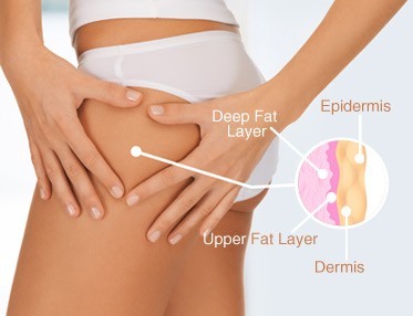 cellulite edematosa