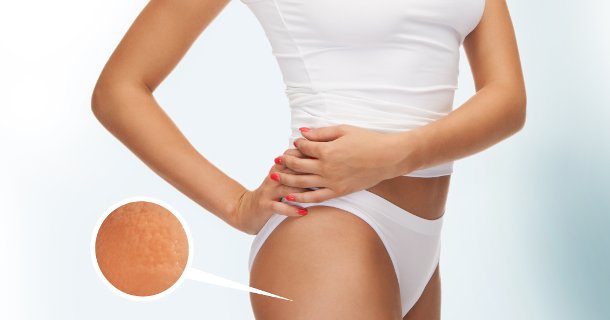 Cellulite Reduction Therapy