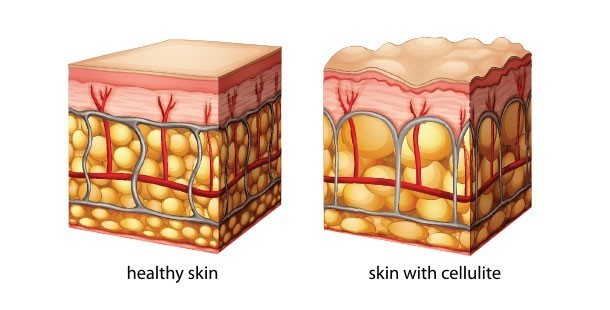 What Is Cellulite