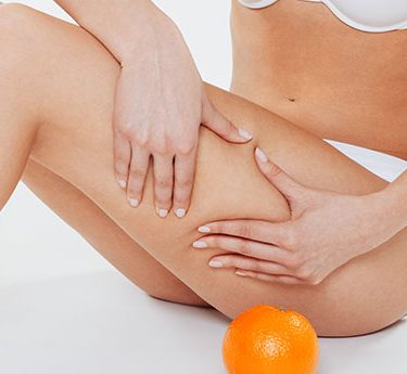 Cellulite – Diagnosis and Treatment