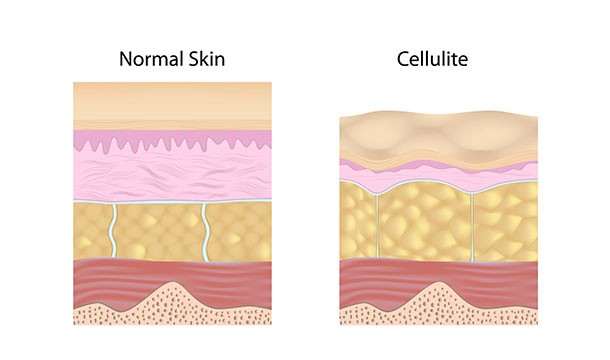 Cellulite Reduction Therapy: Cellulite