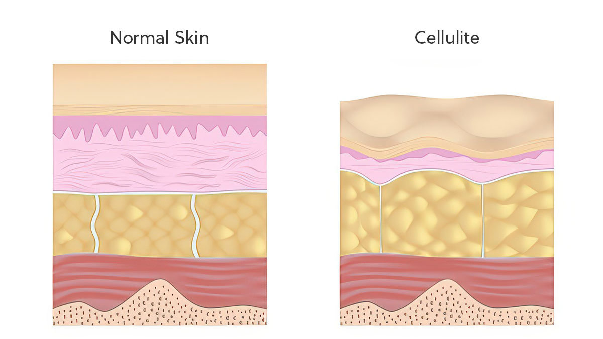 Diagram comparing normal skin and cellulite layers, showing structural differences in fat and connective tissue.